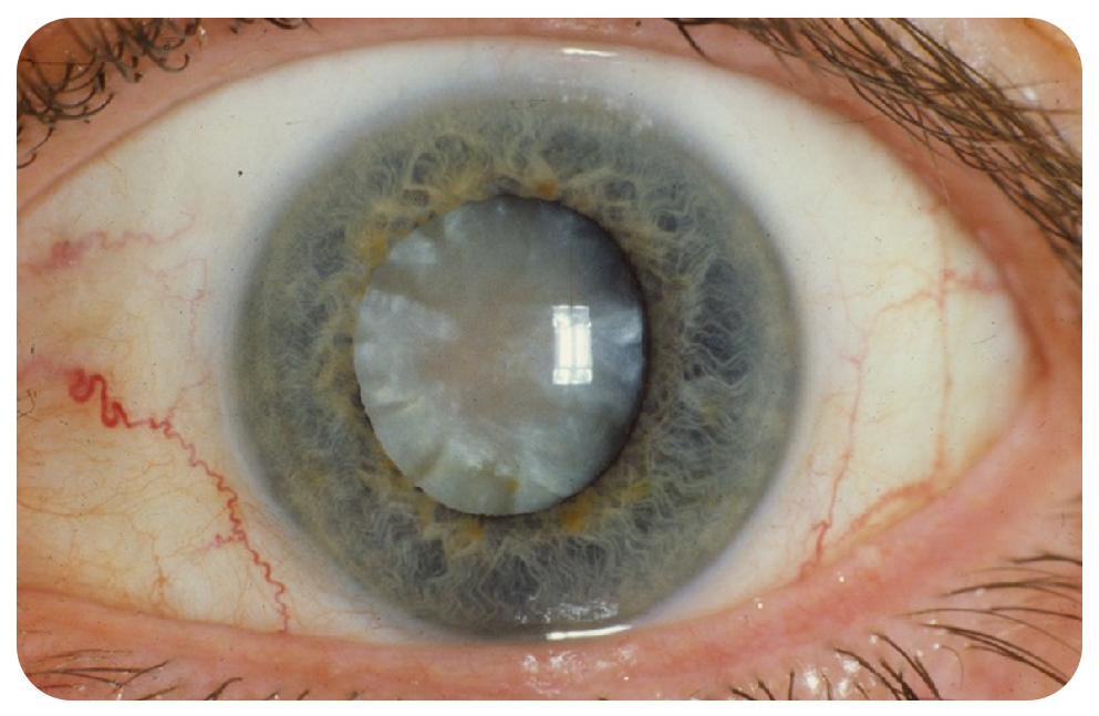 Cataract Surgery